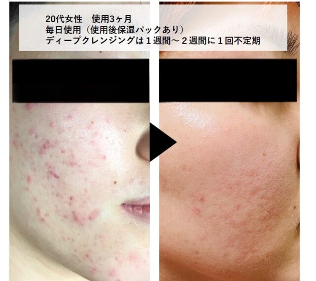 ニョキニョキ角栓とれる！メディケアポアレスクレンジングジェル