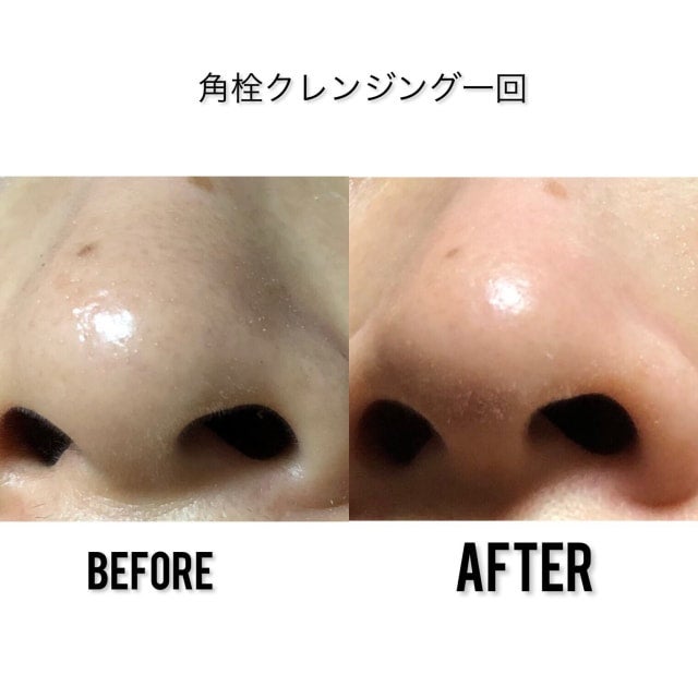 ニョキニョキ角栓とれる！メディケアポアレスクレンジングジェル