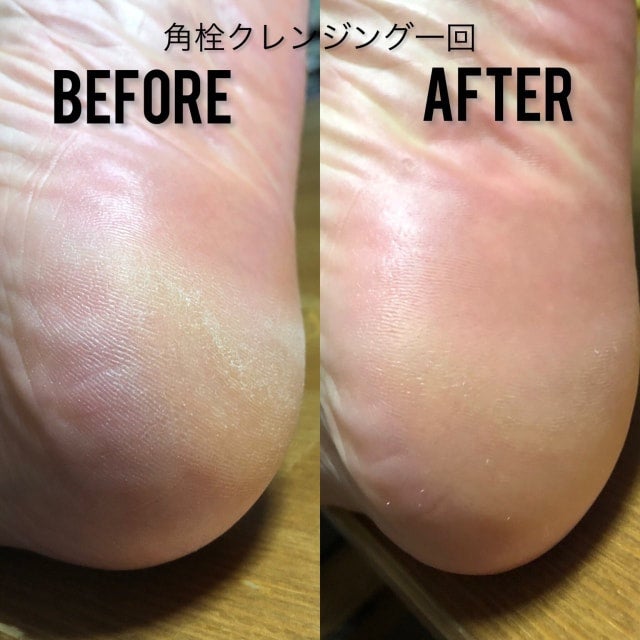 ニョキニョキ角栓とれる！メディケアポアレスクレンジングジェル